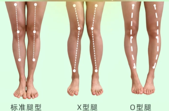 “X”型腿、“O”型腿治疗